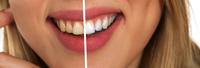 牙齿美白能管多久 牙齿变黄的原因