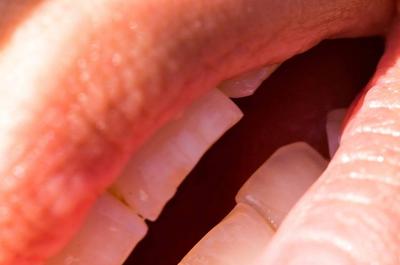 牙周炎会遗传吗