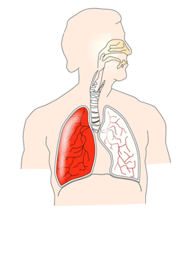 慢性阻塞性肺气肿概念是什么？