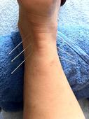 下肢水肿能用针灸治疗吗 下肢水肿针灸治疗的方法