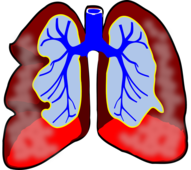 严重肺炎的症状有哪些 治疗肺炎需要用对方法