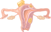 双侧卵巢内见多个囊泡  卵巢多囊泡症状