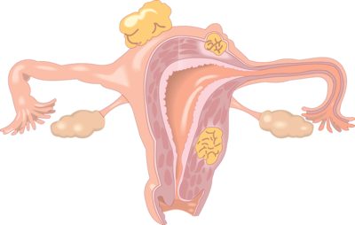 ​子宫内膜移植的结果