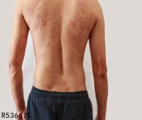 湿疹腿上痒皮肤粗糙 三种方法缓解湿疹症状