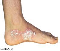 脚水肿皮肤破裂渗水是怎么回事 脚水肿皮肤破裂渗水怎么办