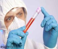 急性肾小球肾炎的病理分解 急性肾小球肾炎的检查方法有哪些