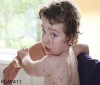 一岁多荨麻疹怎么治疗 宝宝起荨麻疹有哪些需要注意
