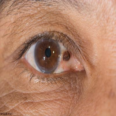 ​老年人养生 老年人视力模糊小心这些病
