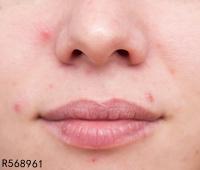 为什么鼻子周围长痘痘 常见的原因有哪些