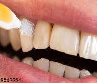 一般洗牙和激光洗牙的区别是什么 帮助大家正确洗牙