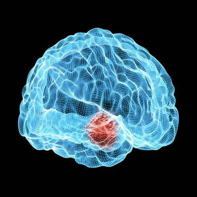 癫痫发作对大脑的影响严重吗