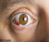 红眼病会复发吗 为什么红眼病会反复发作