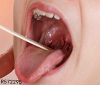 小舌头溃疡不能吃什么 小舌头溃疡饮食禁忌