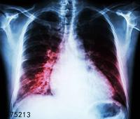 肺栓塞的高危人群有哪些 这三个是肺栓塞的高危人群