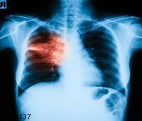 血源性肺脓肿怎么回事 血源性肺脓肿的3个原因浅析
