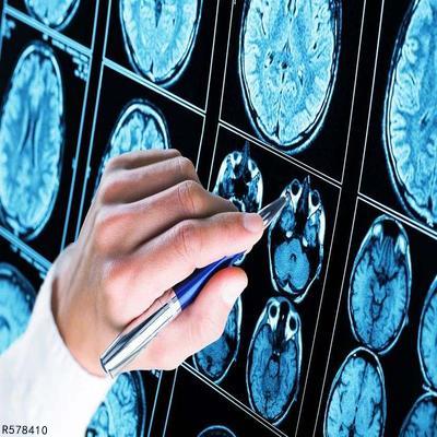 脑电图核磁正常能排除癫痫吗