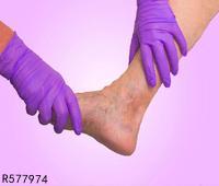 手足癣会引起尿道炎吗 手足癣易引发哪些疾病