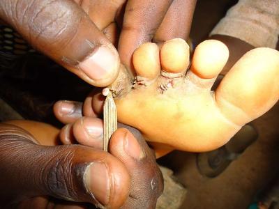 用醋泡脚治疗灰指甲方法有哪些呢