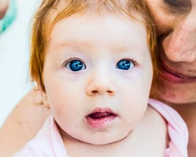 婴儿眼皮红胎记应该如何去除？