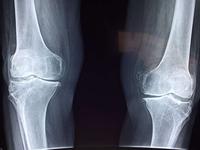 运动膝盖痛会有哪些反应 运动后膝盖疼痛怎么办