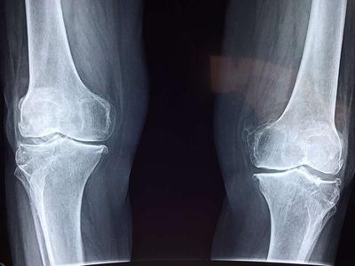 膝关节韧带炎怎么治疗？