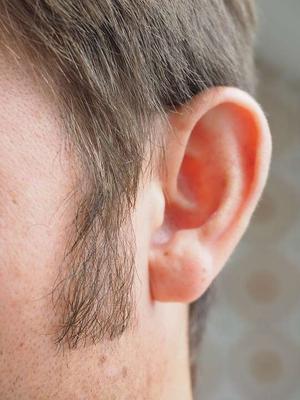 外耳炎怎么办怎样治疗外耳道炎 外耳道炎有哪些护理方法 正确掏耳朵来预防外耳道炎 健康资讯 快速问医生