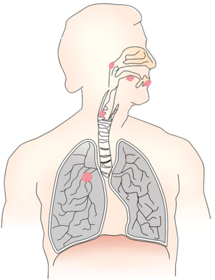 ​​老年性肺气肿有哪些症状