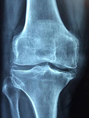 ​老年人膝关节积液有哪些治疗方法