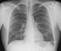 大叶性肺炎如何诊断 了解大叶性肺炎的X线表现