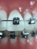 牙颌畸形能不能报销 正畸的过程