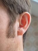 治疗中耳炎可以用什么头孢 中耳炎是什么原因引起的