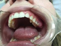骨性龅牙带牙套有用吗 骨性龅牙带牙套需要注意什么