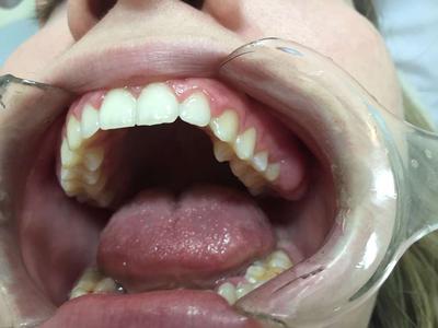 牙龈肿胀牙齿松动的原因
