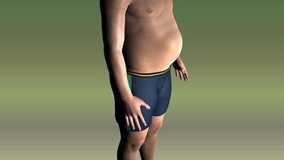 重度肥胖的危害有哪些呢
