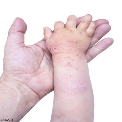婴儿湿疹 如何鉴别宝宝得了湿疹