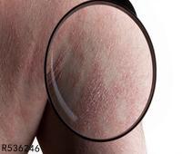 湿疹性毛囊炎怎么办巧用4个方法控制湿疹性毛囊炎