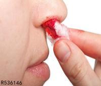 鼻出血的紧急处理方法有哪些 正确方法助你及时止血
