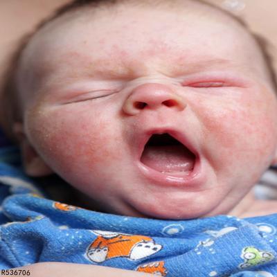 婴儿脸上湿疹怎么办 婴儿面部湿疹食疗方