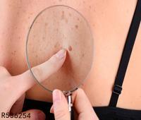 背部皮肤瘙痒治疗方法有哪些 皮肤瘙痒的发病原因是什么