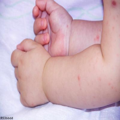 宝宝汗疹症状是什么宝宝汗疹如何去除 汗疹 快速问医生