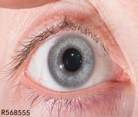 眼屎多是干眼症么 要怎么判断自己患有干眼症