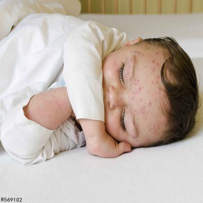 婴儿多少度算发烧 引起婴儿发烧的原因