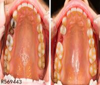 牙槽骨骨折后期并发症 牙槽骨骨折的临床表现