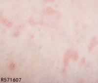 皮肤真菌感染会不会复发 皮肤真菌感染如何治疗