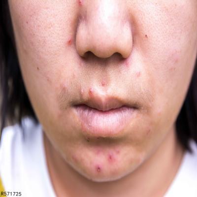 ​野菊花洗脸祛痘吗？还有哪些祛痘方法？