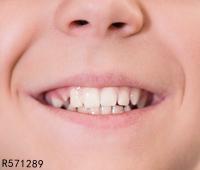 儿童补牙后注意什么 儿童补牙的重要性
