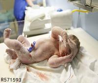 宝宝生下来漏斗胸会有什么影响 小儿漏斗胸的临床表现