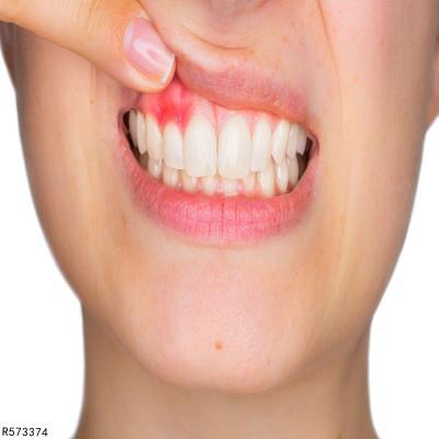 为什么刷牙时牙龈总出血？ 这是怎么回事