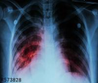 肺结核会死人吗 导致肺结核的原因是什么