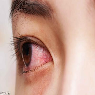 结膜炎一个月了眼球上还有红血丝怎么办 疾病 快速问医生 有问必答